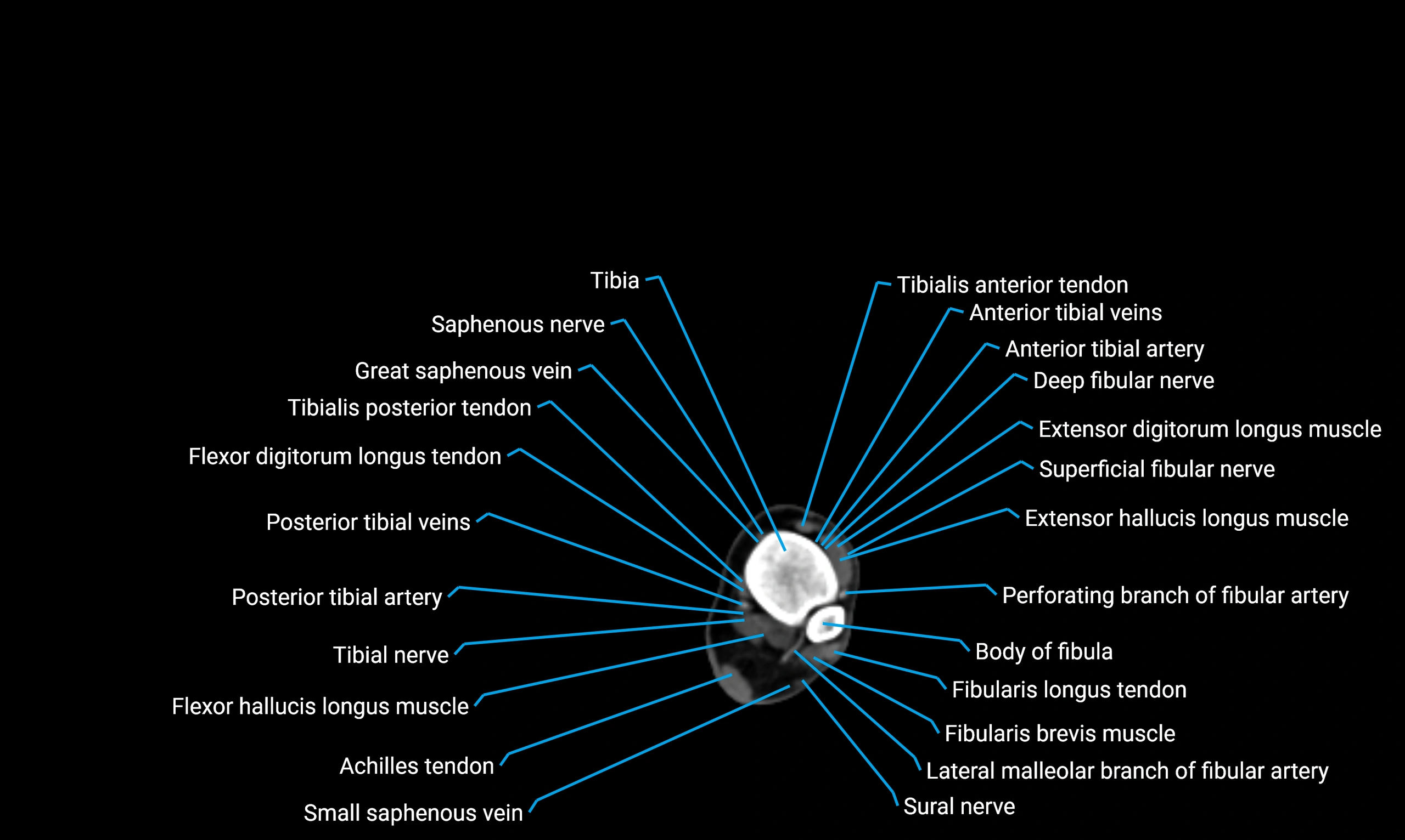 CT lower limb axial cross sectional anatomy labelled image 162 (2).webp